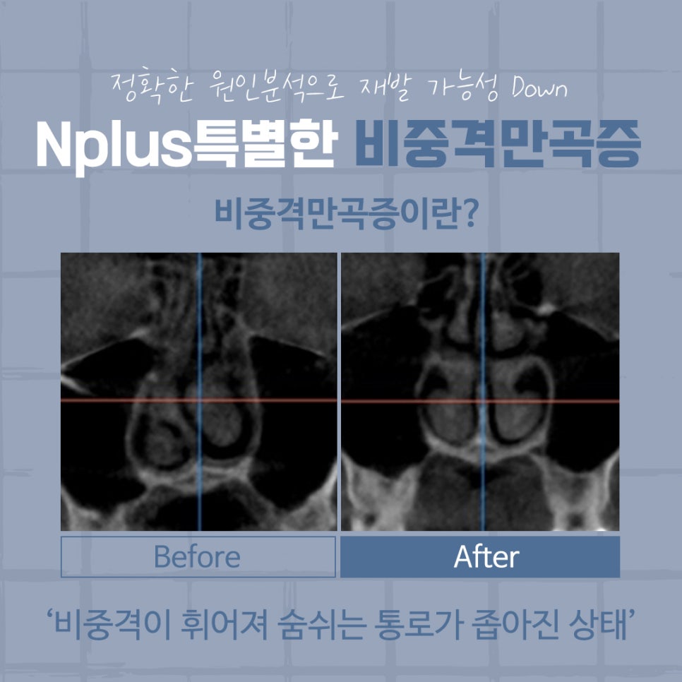 The Importance of Choosing a Septoplasty Review image 2