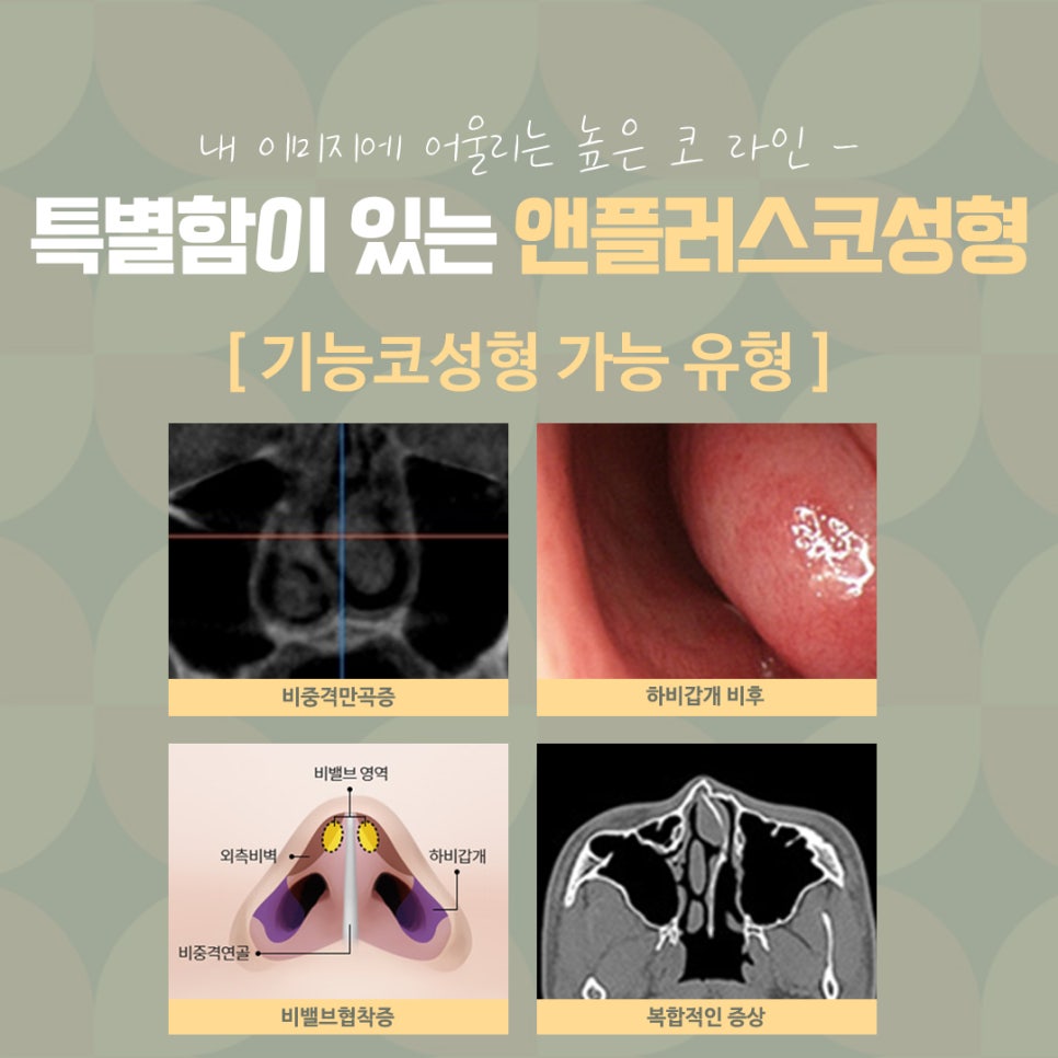 직반버선코 라인으로 교정된 코수술후기 관련 이미지 6