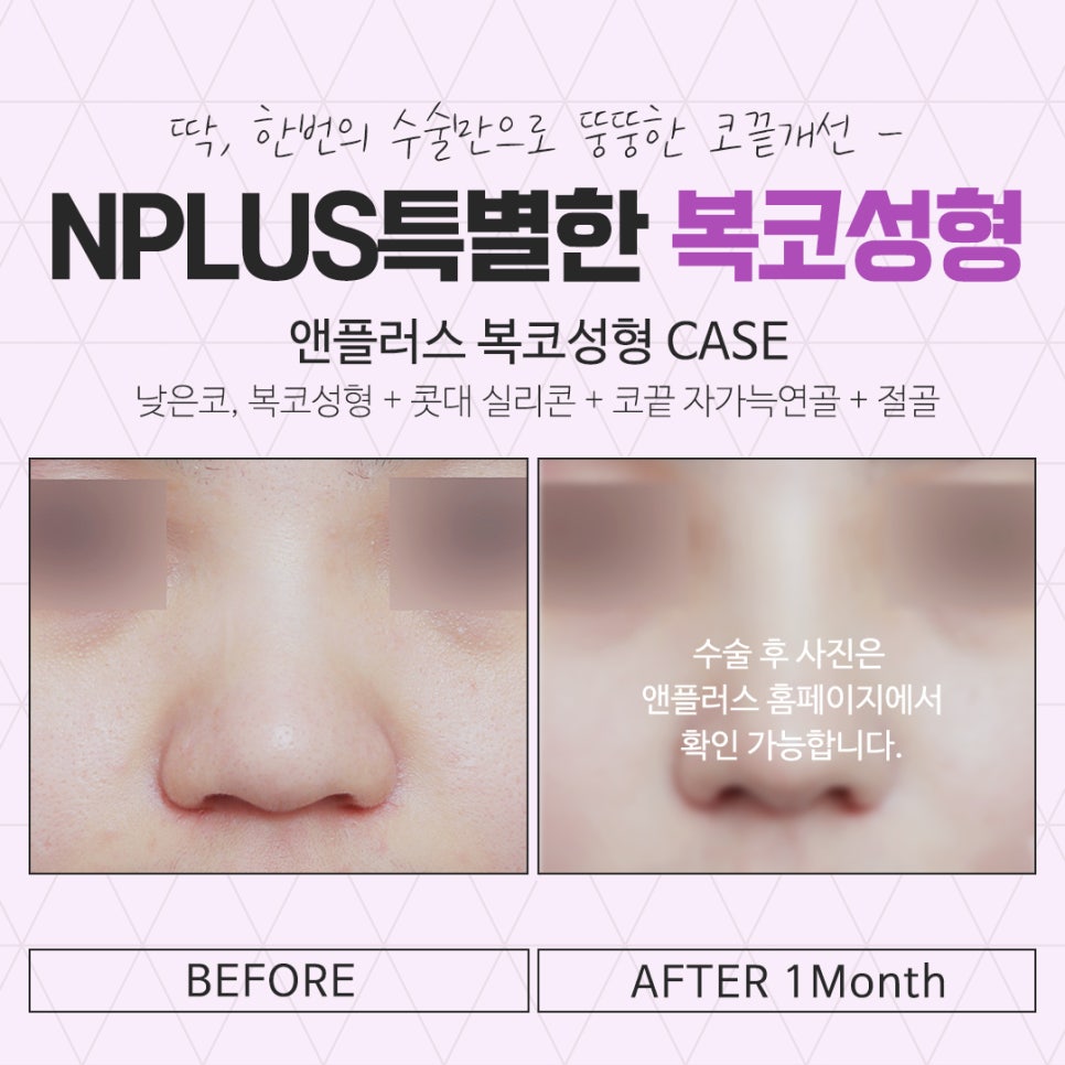 복코수술후기에 대해 세세하게 알아보고 관련 이미지 16