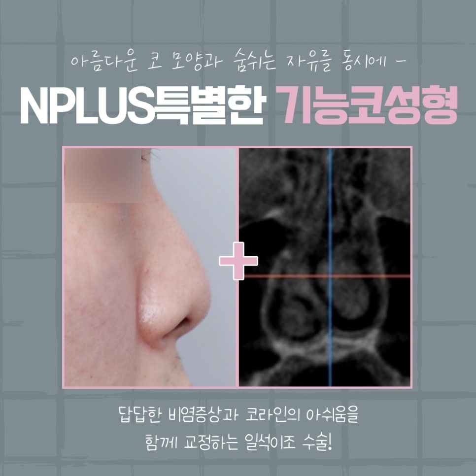 코성형후기 자연스럽고 예쁘게 관련 이미지 4