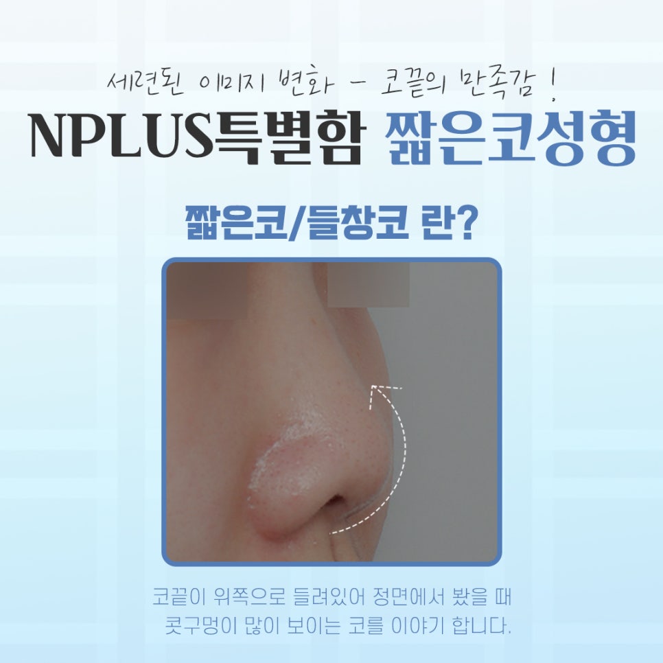 Short Nose Surgery for a Harmonious Line image 3