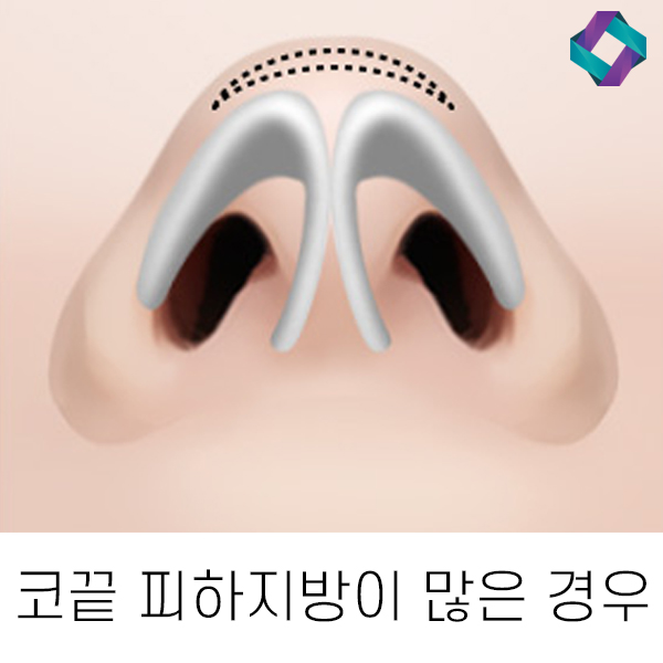 복코성형 유형에 따라 다른 수술방법 관련 이미지 2