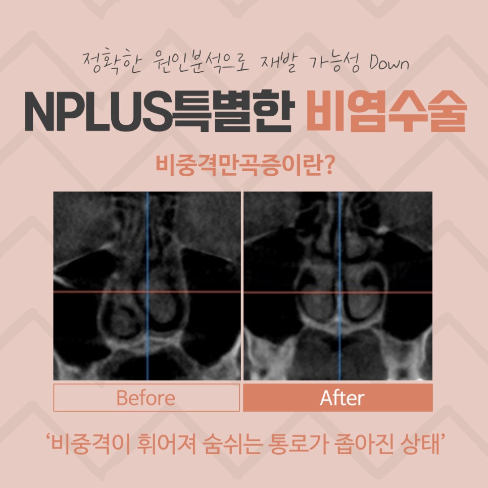 비중격수술후기 정확하게 파악해야 관련 이미지 4
