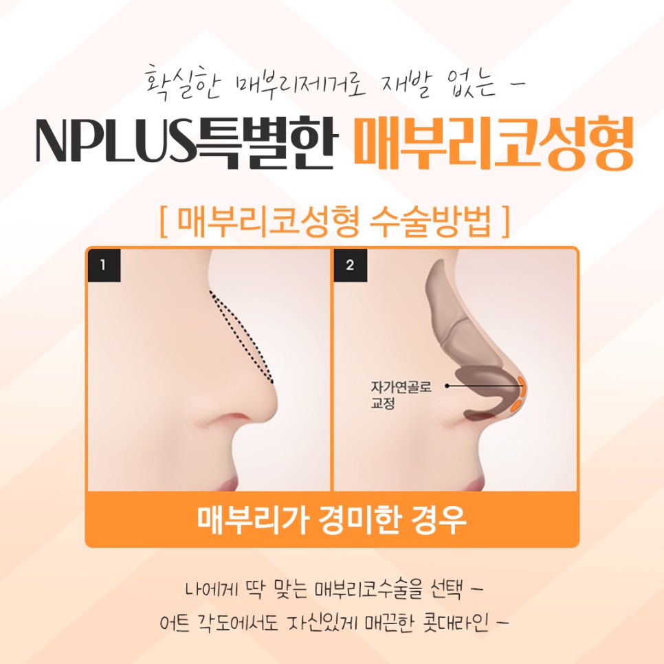 매부리코성형후기를 자세하게 알아보고 관련 이미지 10