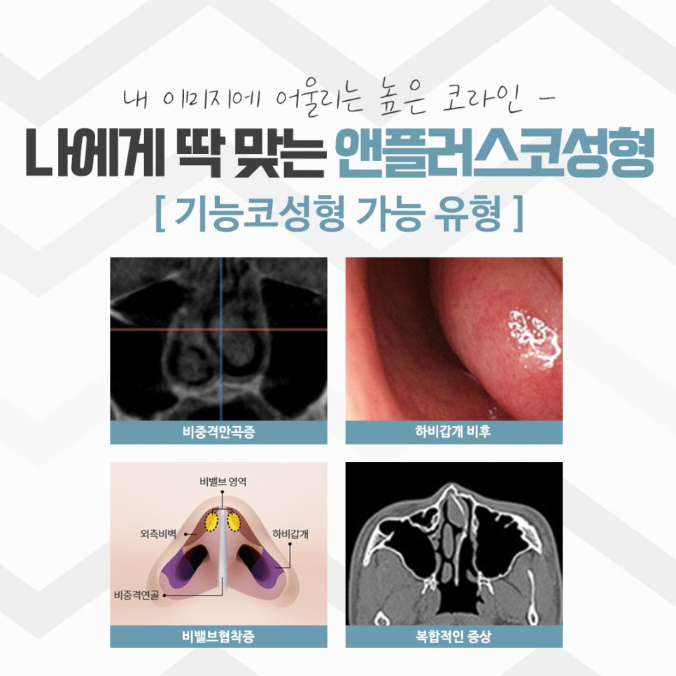 Rhinoplasty Review: Improved with a Refined Line image 13