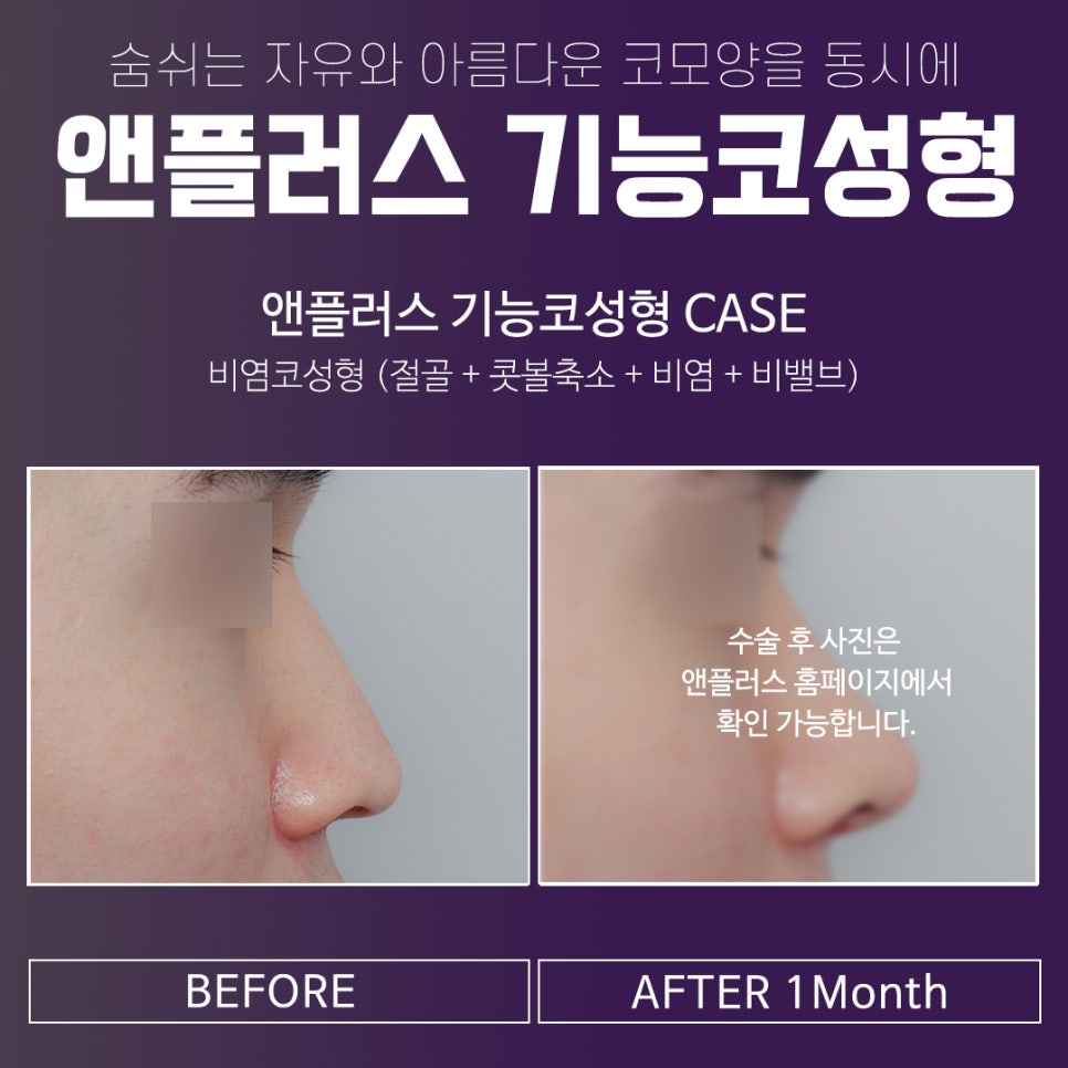 앤플러스에서 알려드리는 성형외과 기능코성형후기 관련 이미지 7