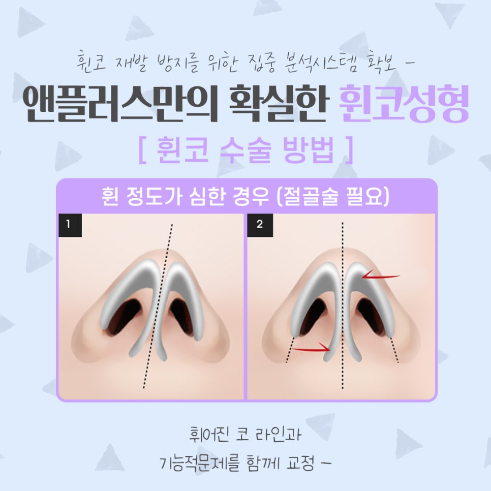 Taking a Thorough Look at Functional Deviated Nose Surgery image 10
