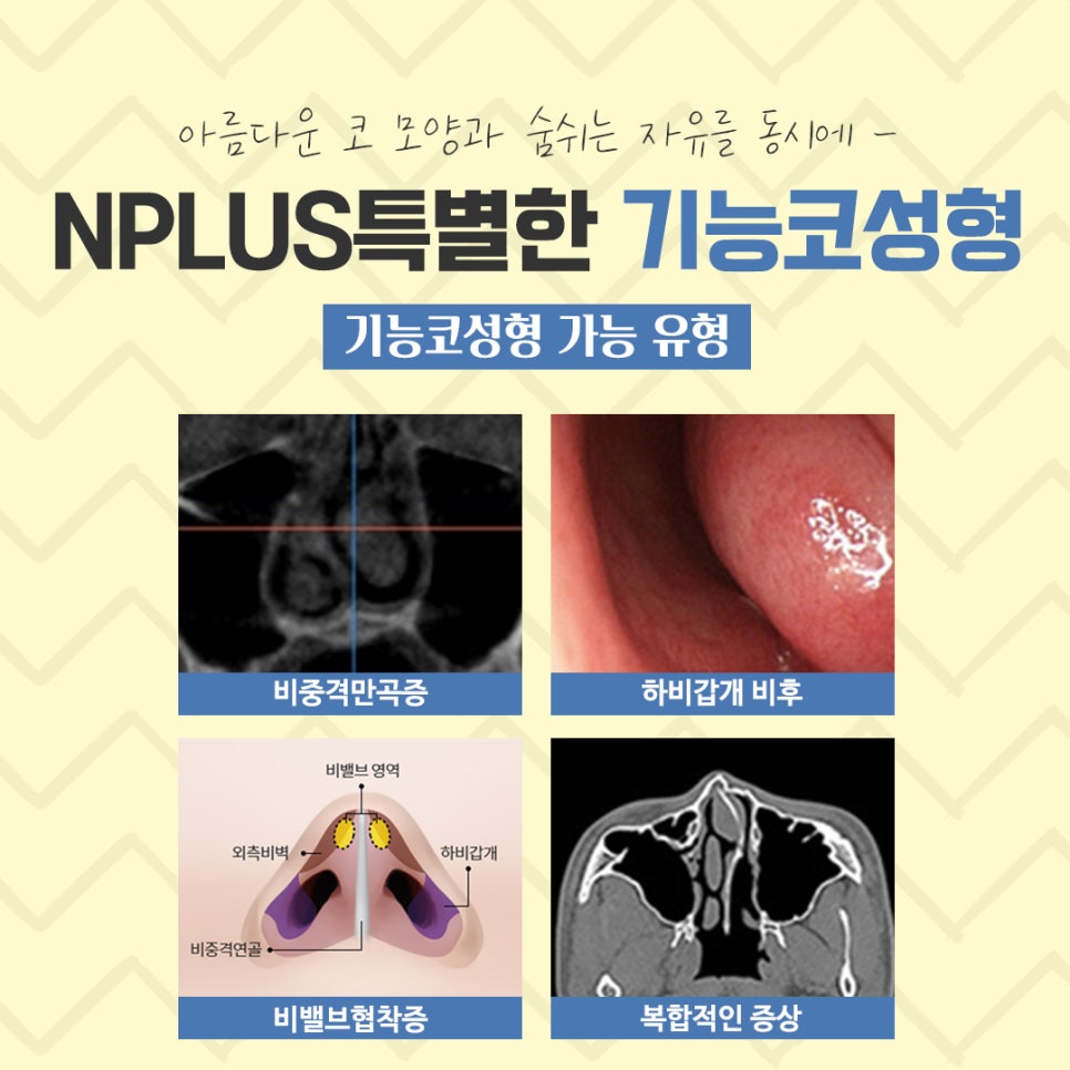 A Clear Choice for Rhinitis Nose Surgery image 4