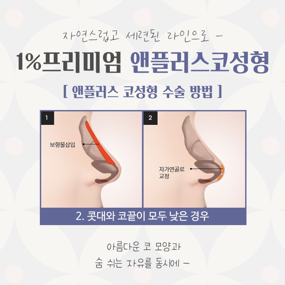 자가늑연골코성형으로 자연스럽지만 화려한 코 라인! 관련 이미지 8