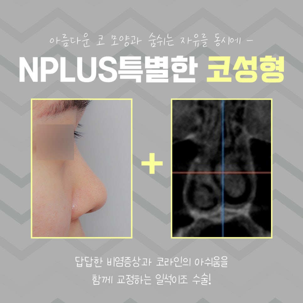 코수술전후 확실한 변화로 관련 이미지 4