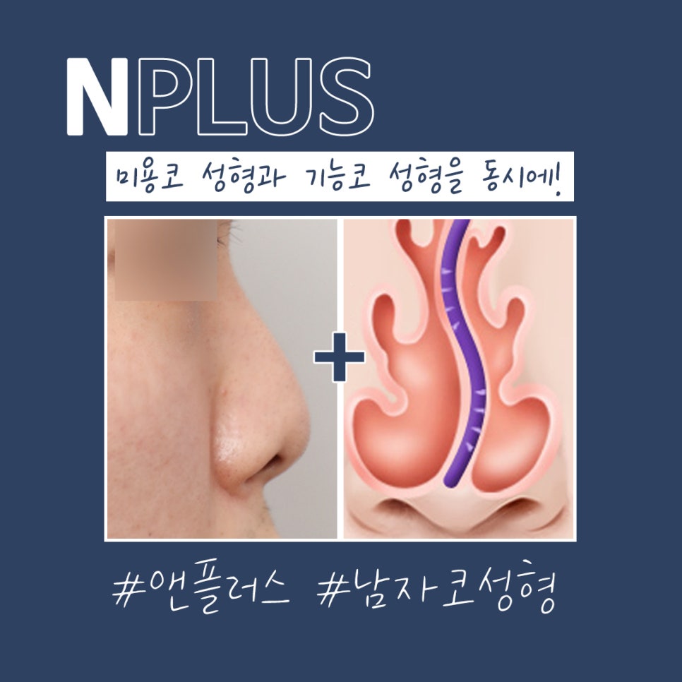 Male Rhinoplasty Review: Taking Functional Aspects into Consideration image 6