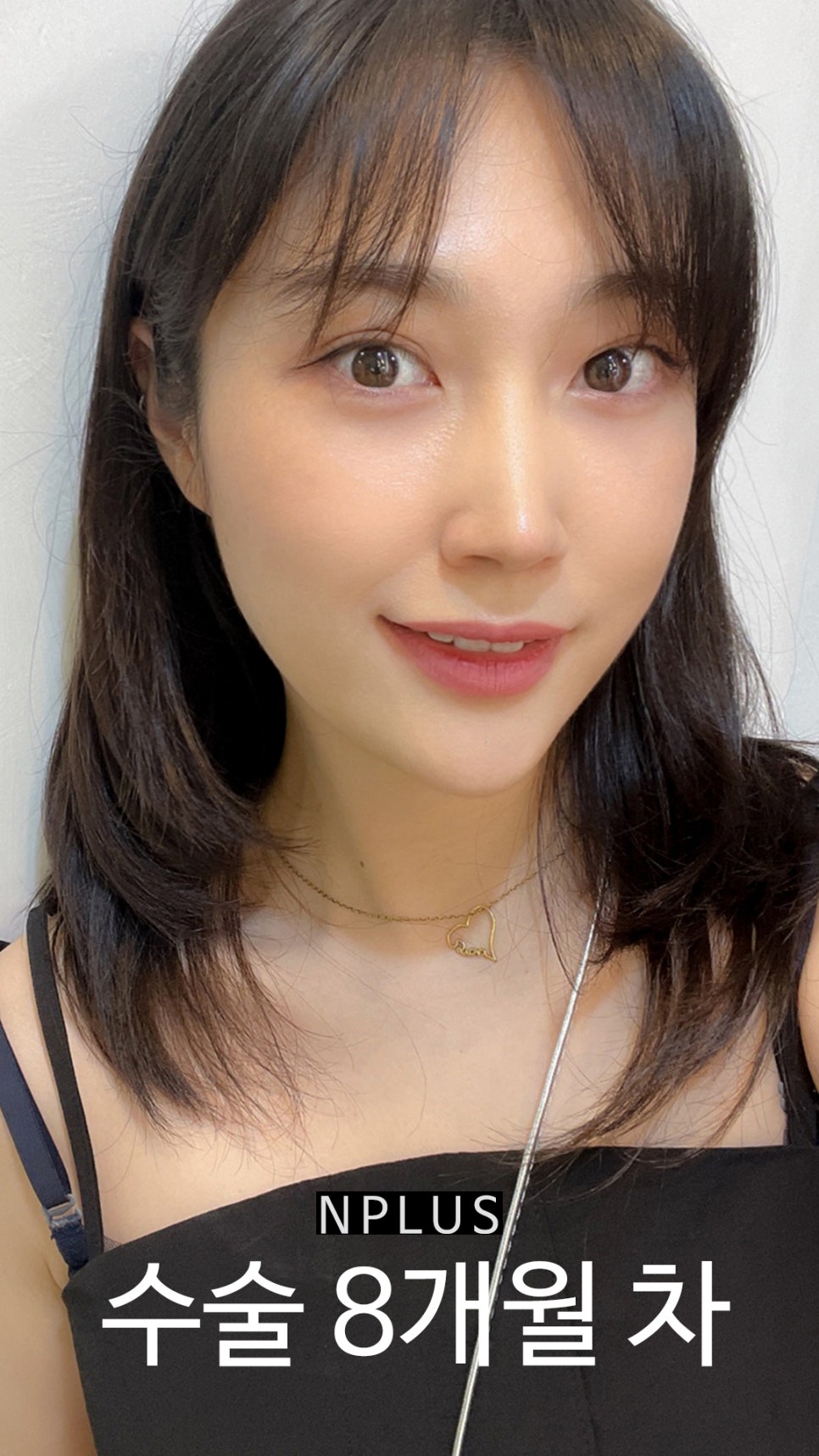 앤플러스에서 진행된 매부리코성형후기 관련 이미지 11