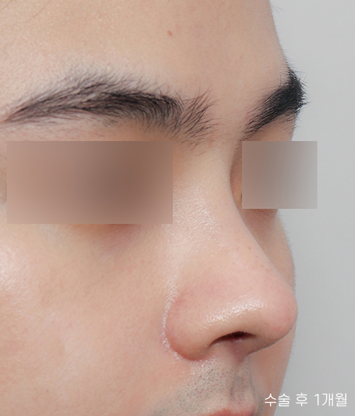Natural and Satisfying Non-Implant Nose Surgery for Men image 5