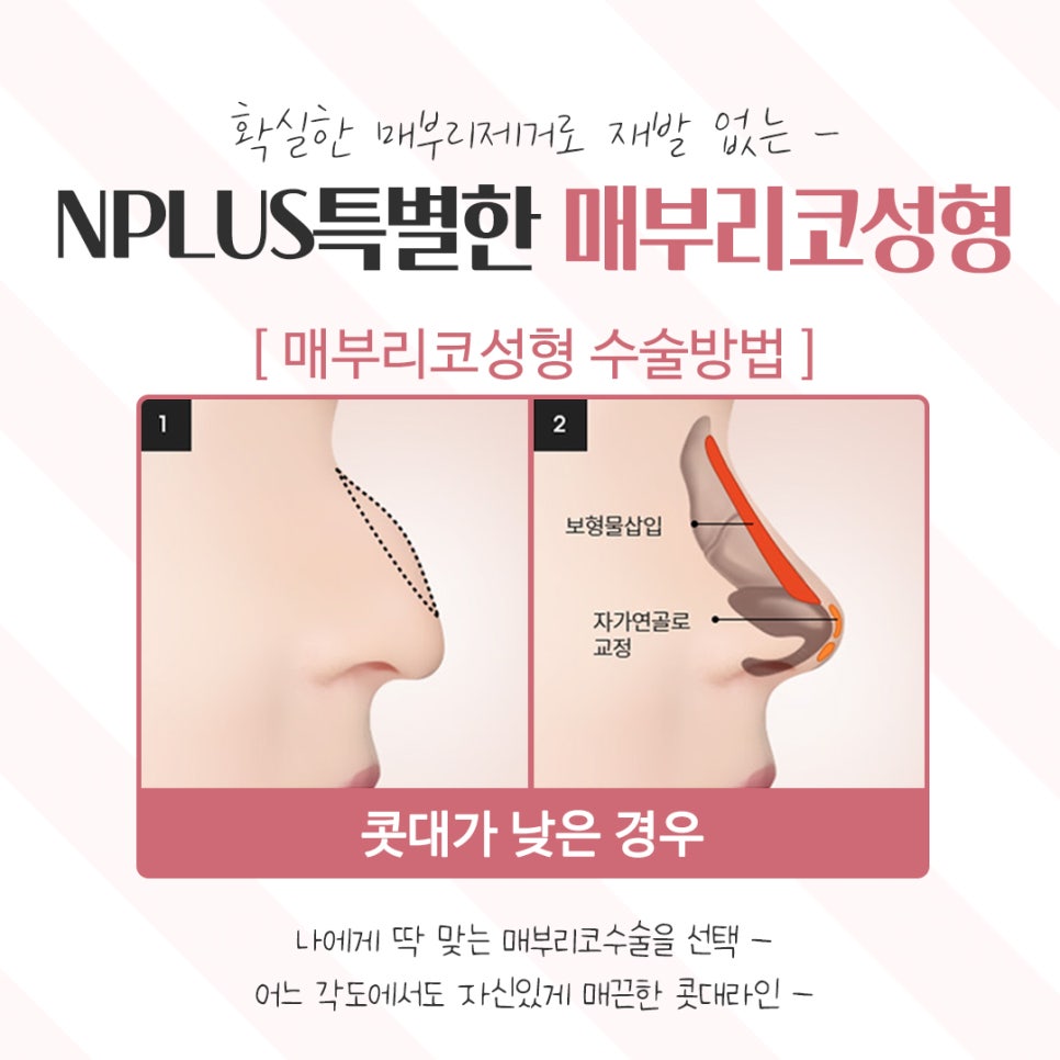 Taking a Detailed Look at Hump Nose Surgery Reviews image 10