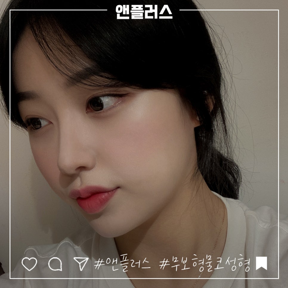 Non-Implant Rhinoplasty: Natural and Safe image 10