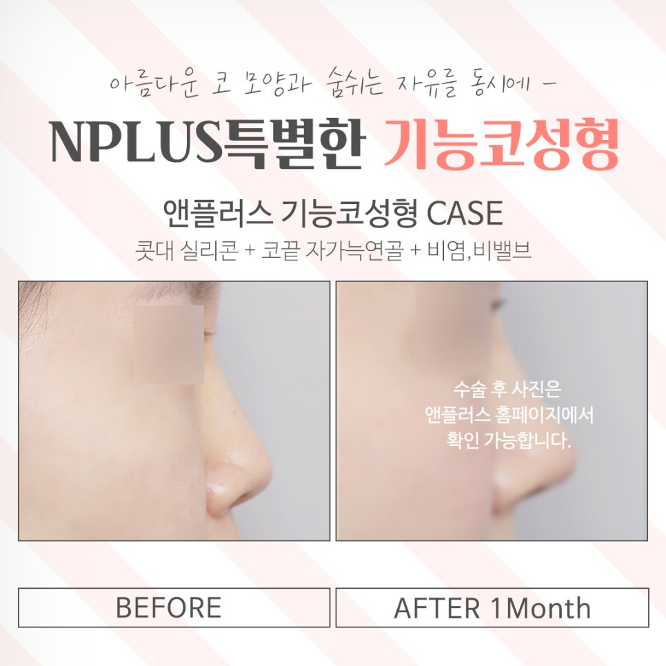 기능코성형후기 다양한 정보를 알아보고 관련 이미지 15