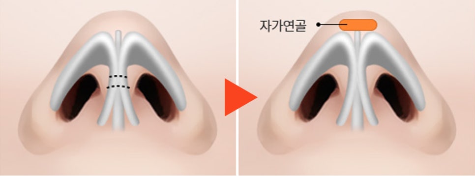 복코수술후기_뭉툭한 코라인을 자연스럽게 관련 이미지 7