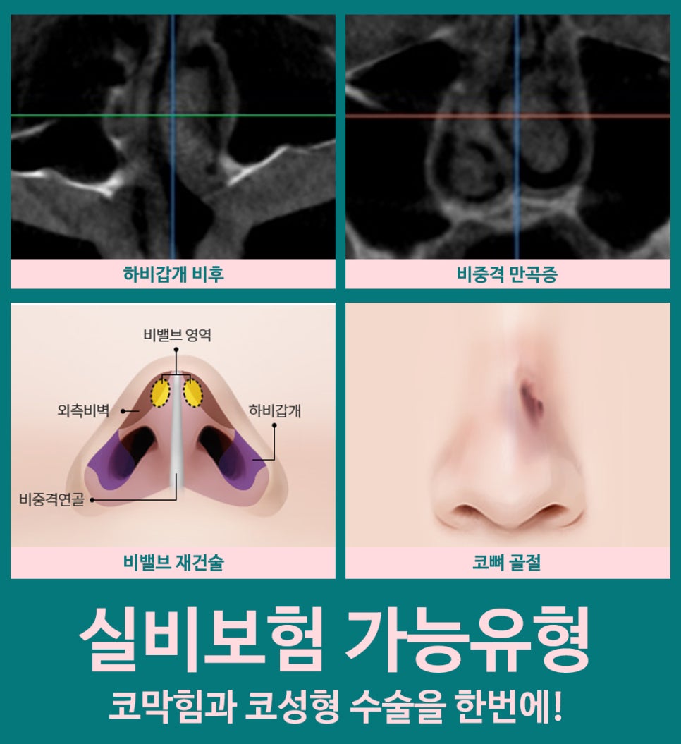 비염실비 꼼꼼하게 알아보고 체크하자 관련 이미지 6