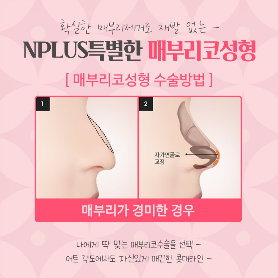 매부리코성형후기 내부까지 확인하고 관련 이미지 11