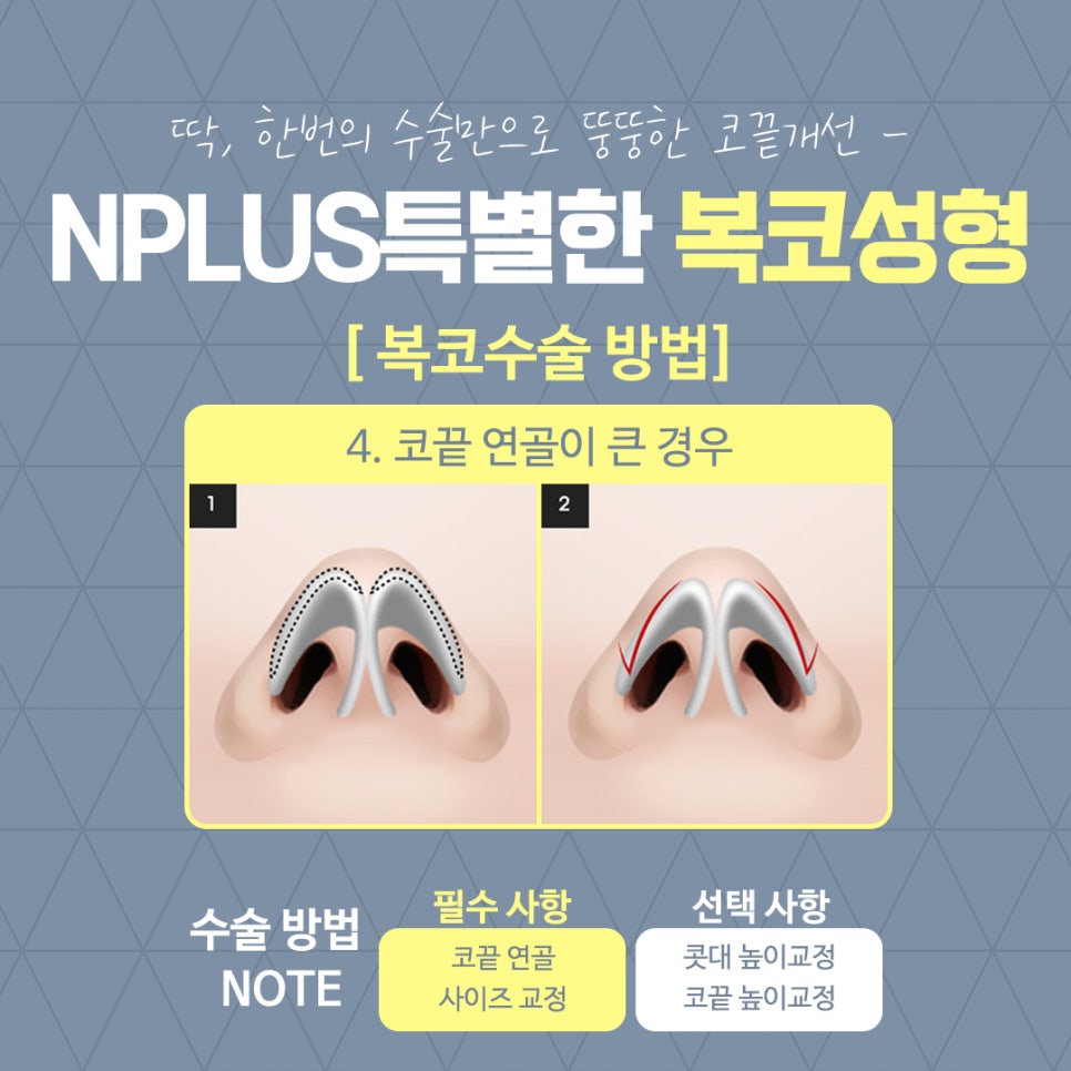 복코수술후기를 통해 예쁜 코라인으로 관련 이미지 12
