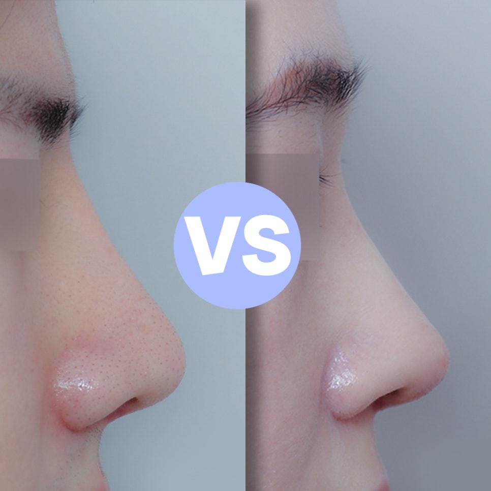 Rhinoplasty Review for Improving a Large Male Nose image 8