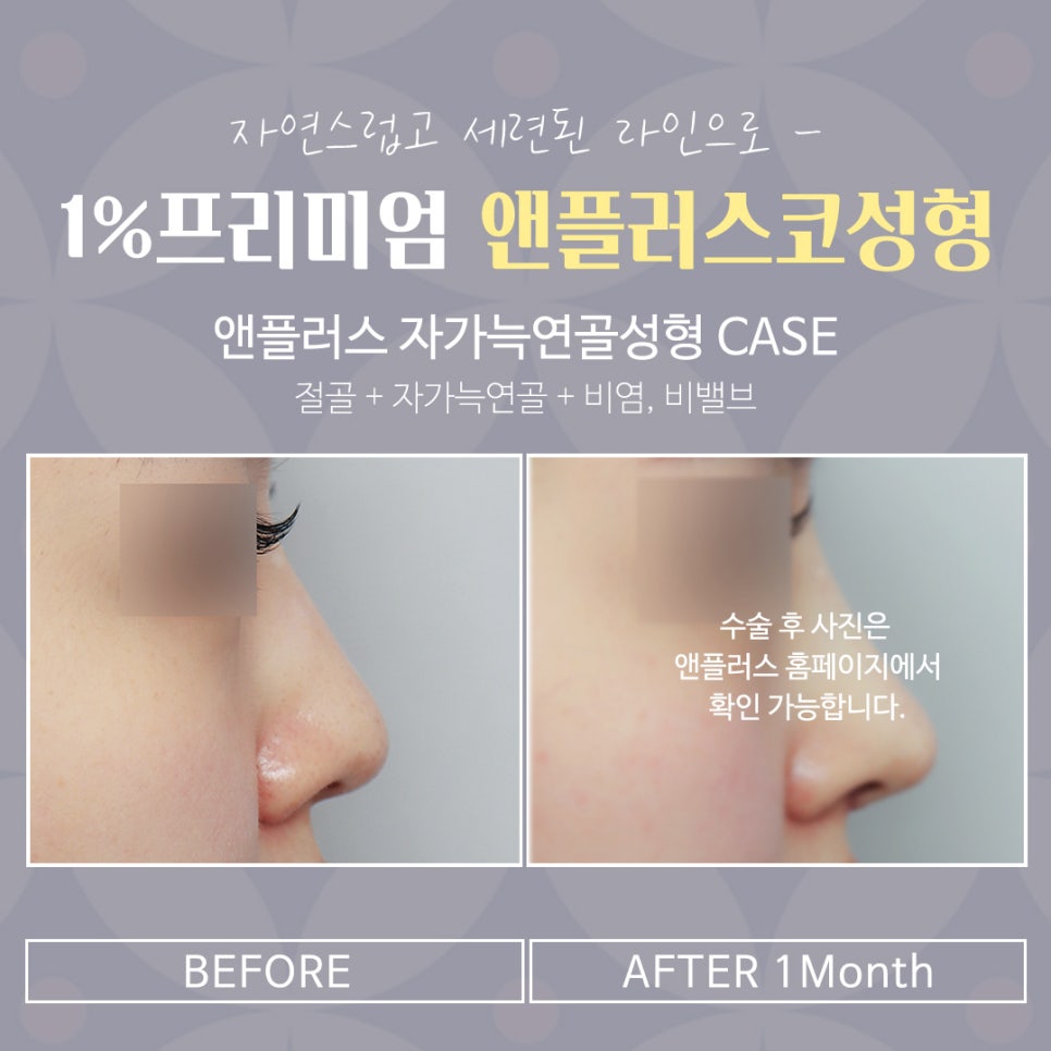 자가늑코수술 정확한 진단으로 관련 이미지 15
