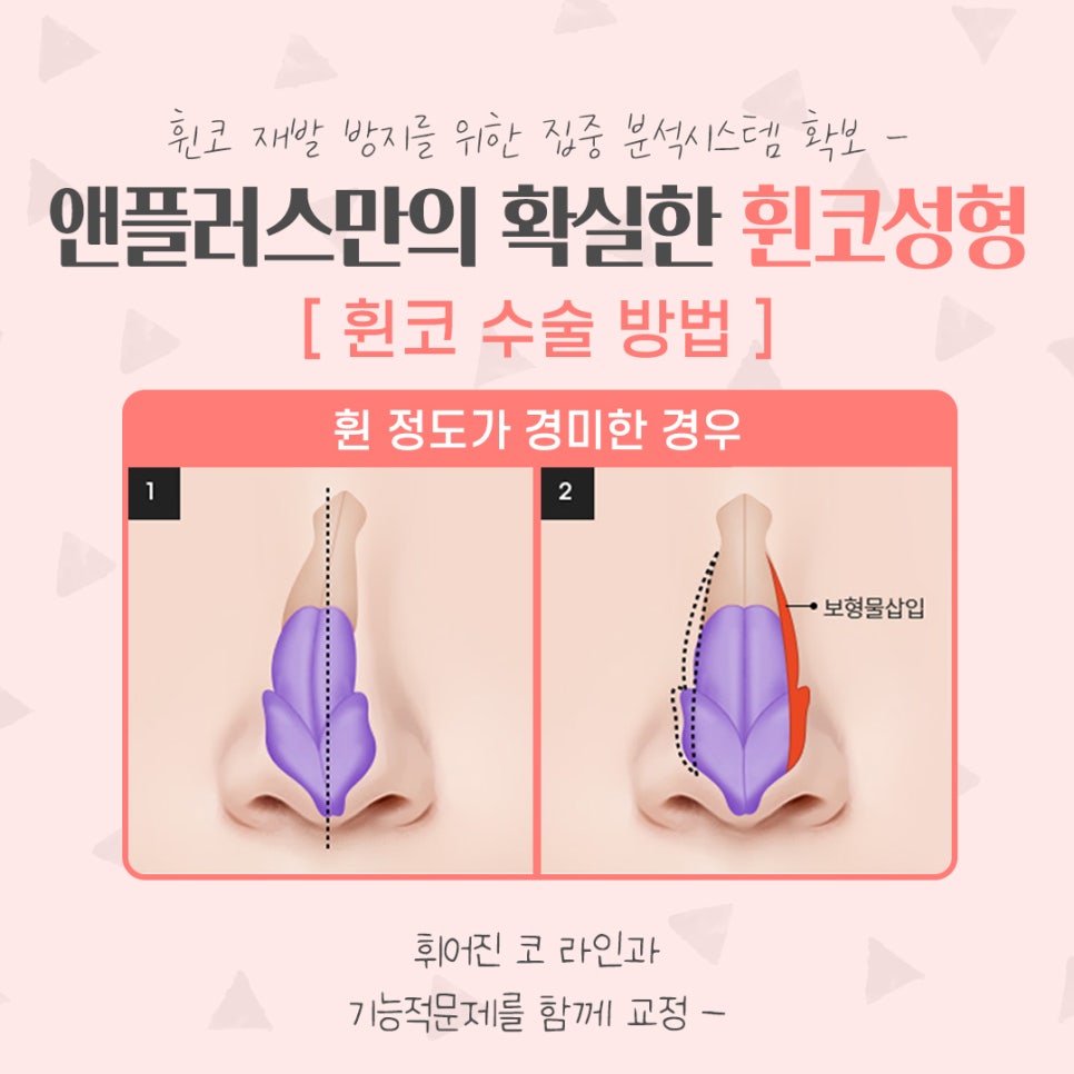 휜코수술후기 정확한 진단을 통해 관련 이미지 7