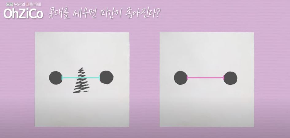 코성형 후 눈몰림 걱정된다면? 관련 이미지 7