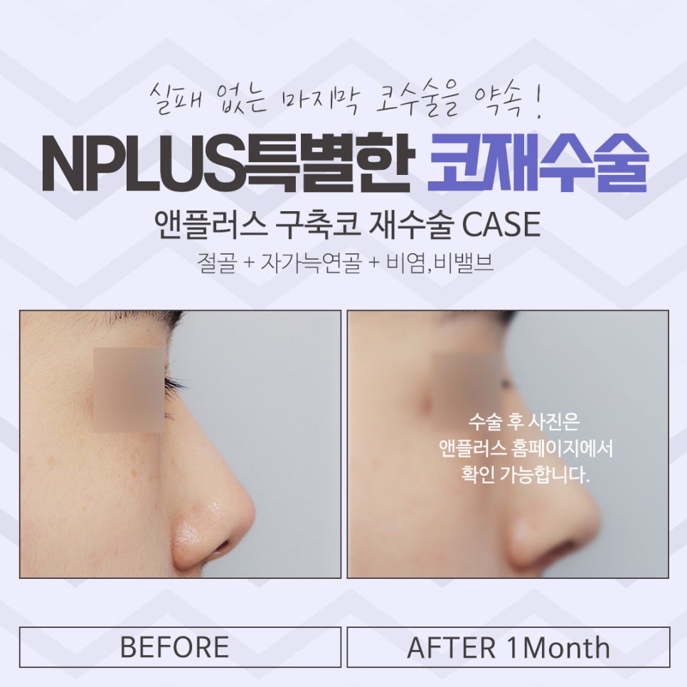 코재수술 후기까지 확실하게 관련 이미지 14