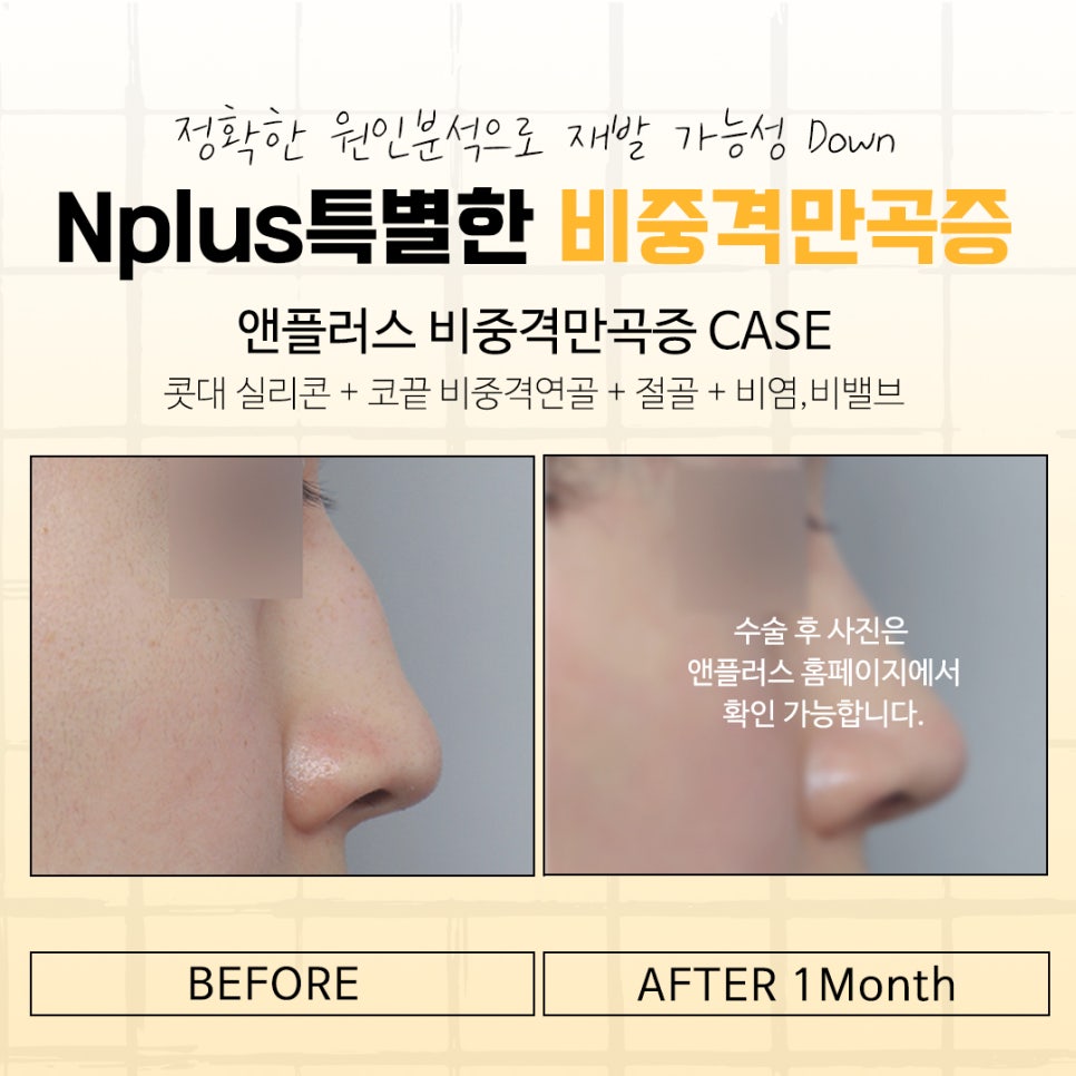 비중격만곡증수술후기에 대해 신중하게 찾아보고 관련 이미지 14