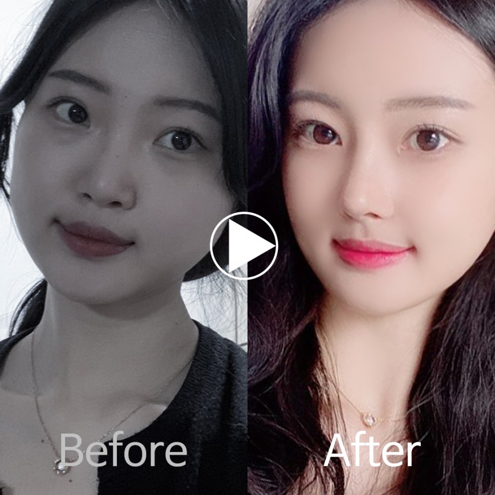 🎀앤플러스 코성형 모델모집🎀 관련 이미지 4