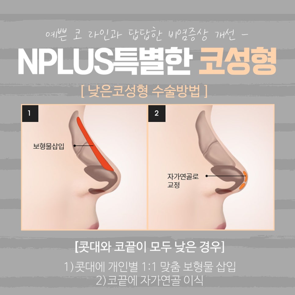 The Importance of Choosing Low Nose Augmentation Reviews image 8