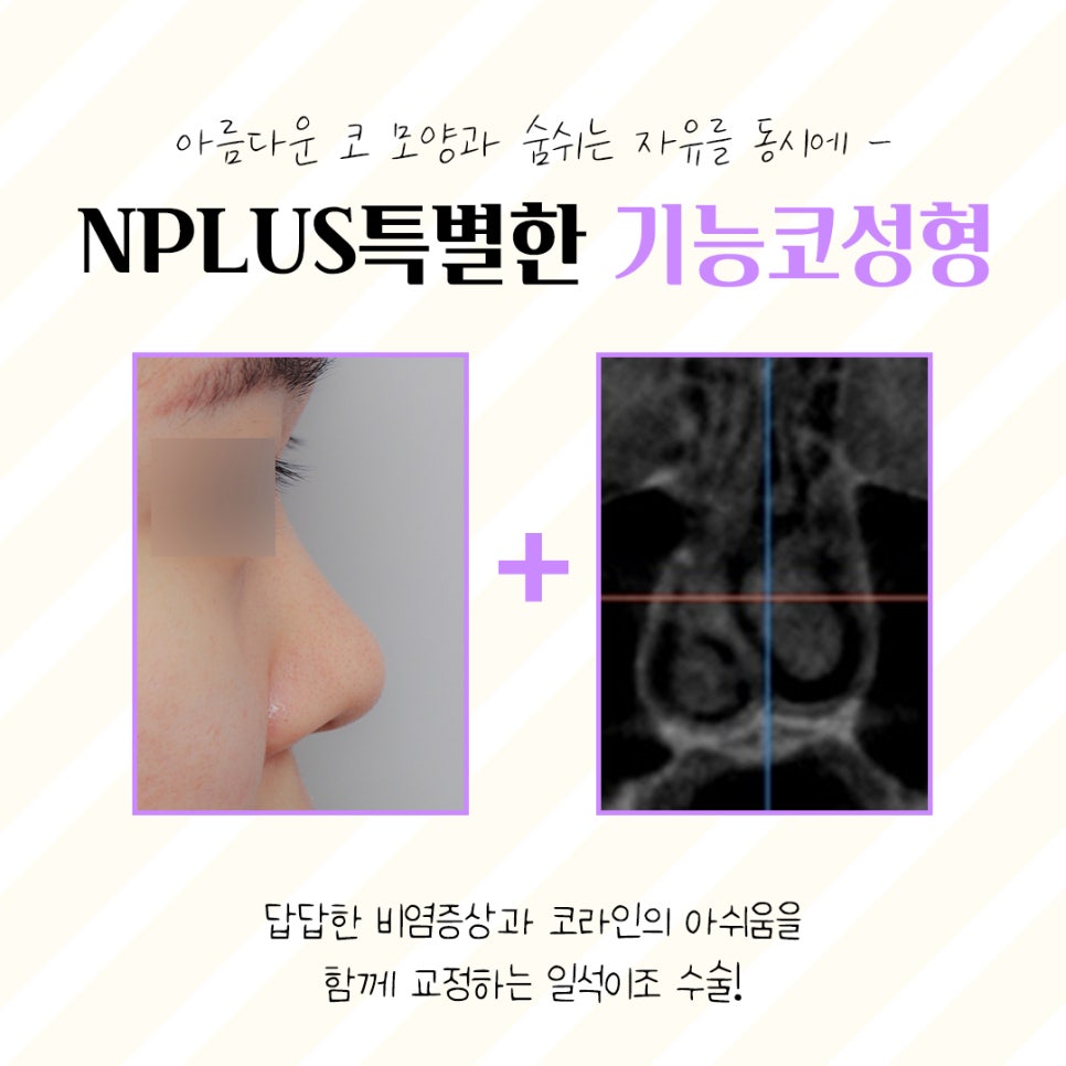 Accurately Reviewing Rhinoplasty Experience image 4