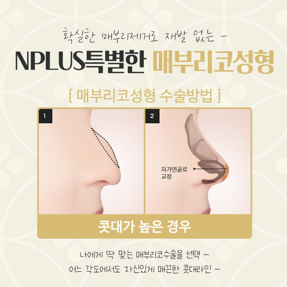 매부리코수술후기 확인하고 부드러운 인상으로 관련 이미지 10