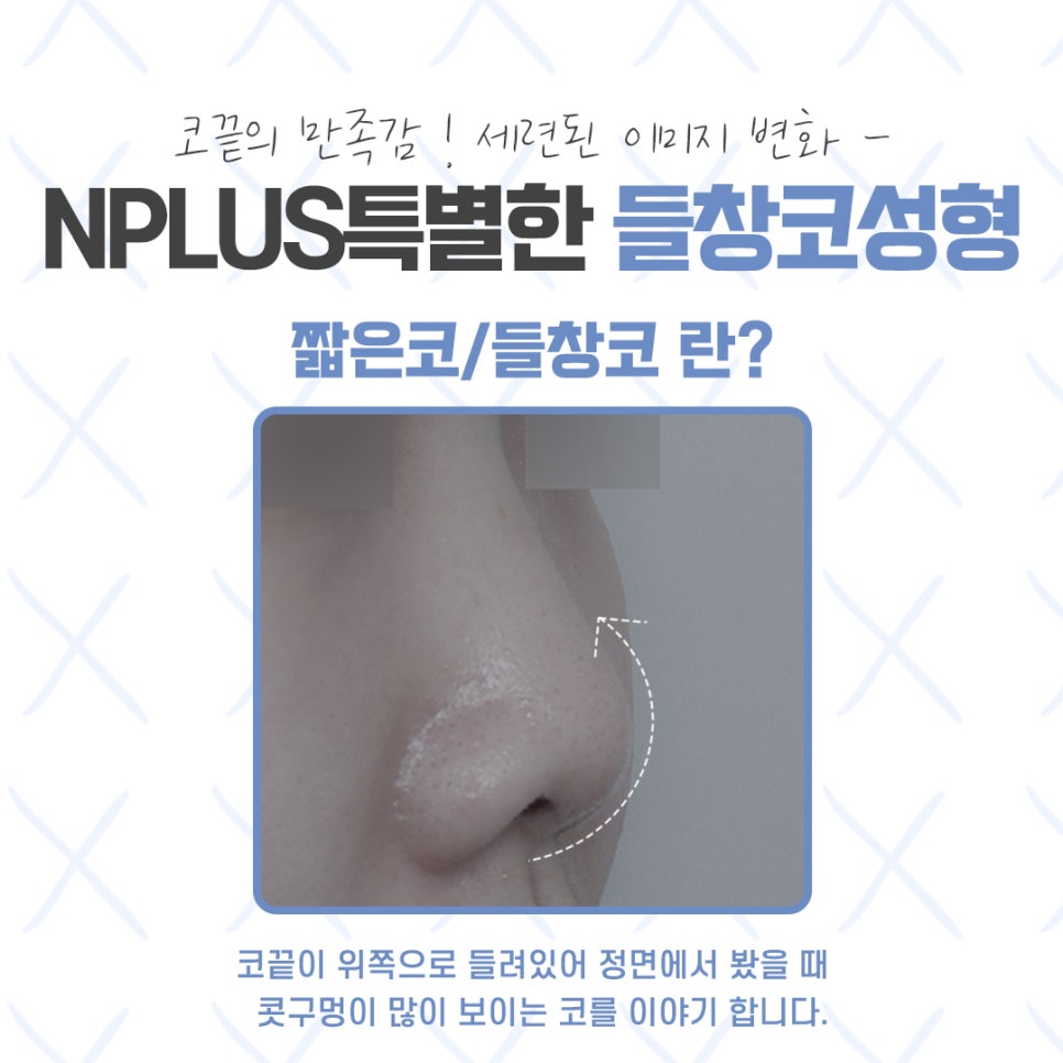 Upturned Nose Surgery for a Harmonious Look image 4