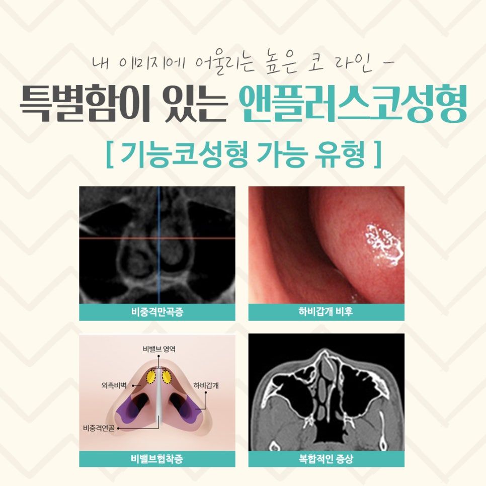코수술후기 자세하게 알아보고 판단 관련 이미지 5