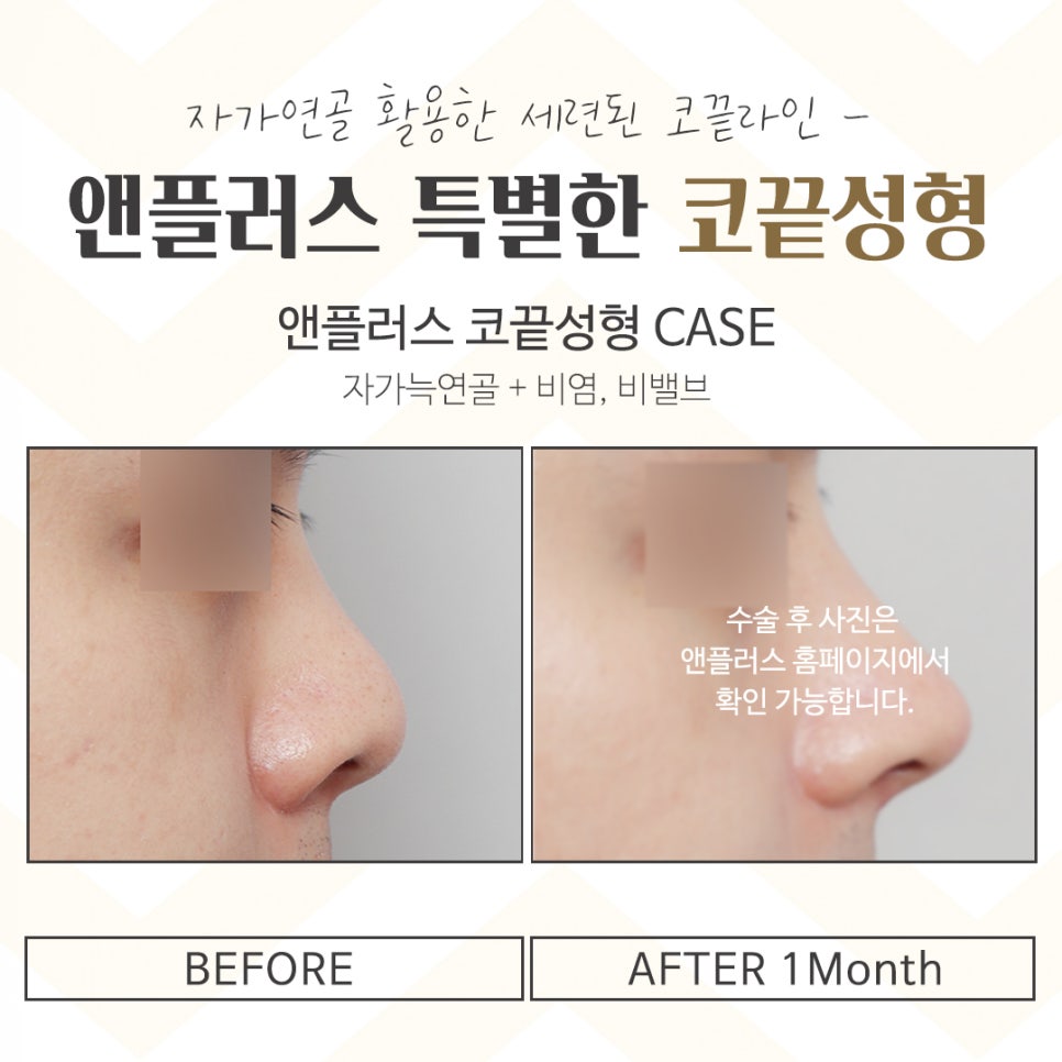 Looking at the Differences in Nose Tip Surgery Reviews image 15