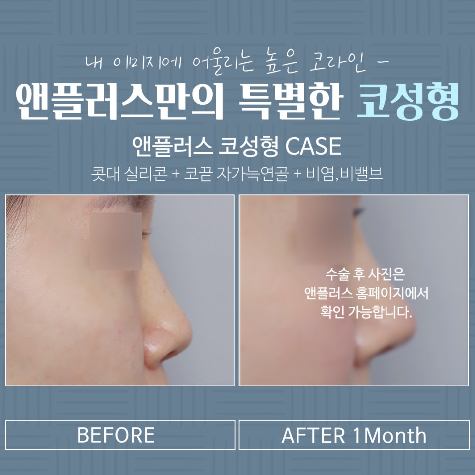 코수술전후 기능까지 확인하고 관련 이미지 16
