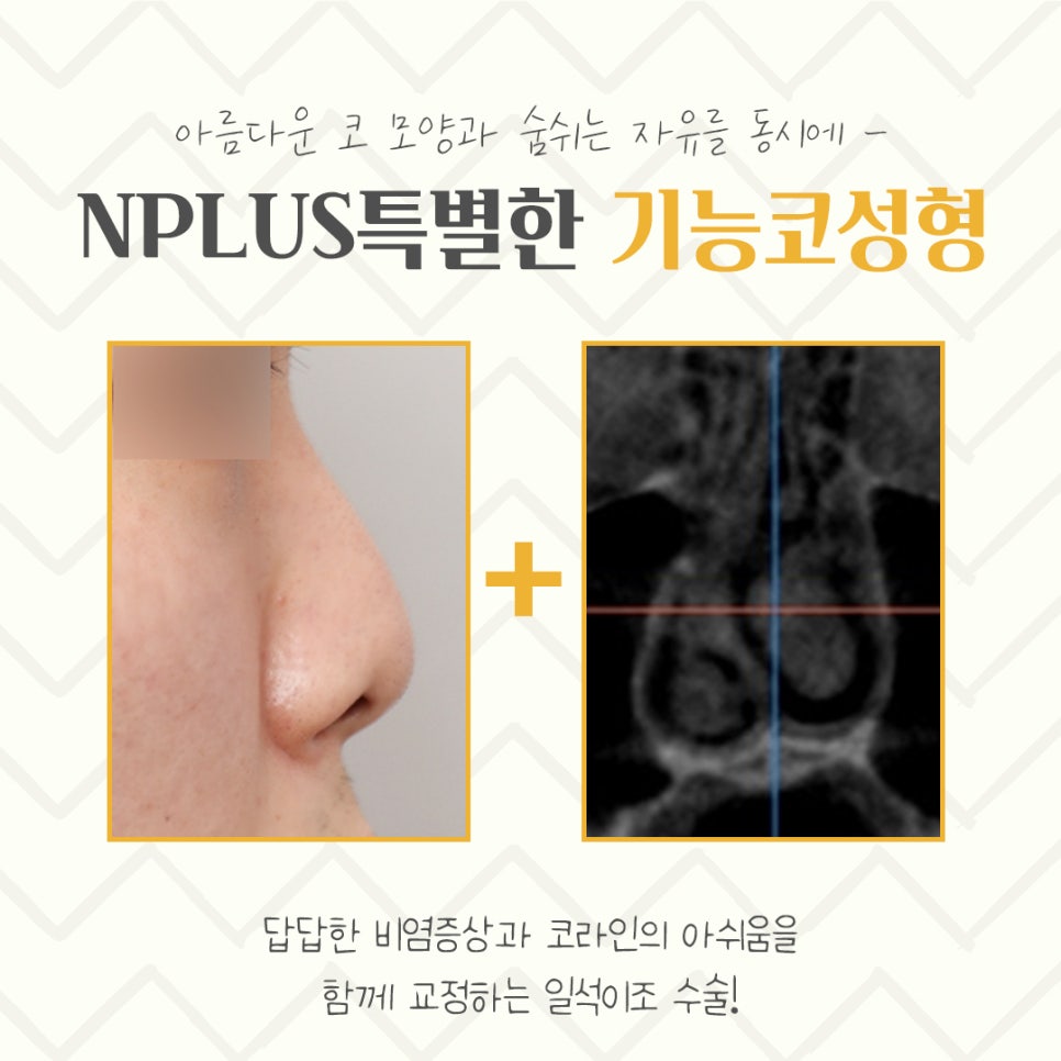 기능코성형후기 이미지를 고려하여 관련 이미지 3