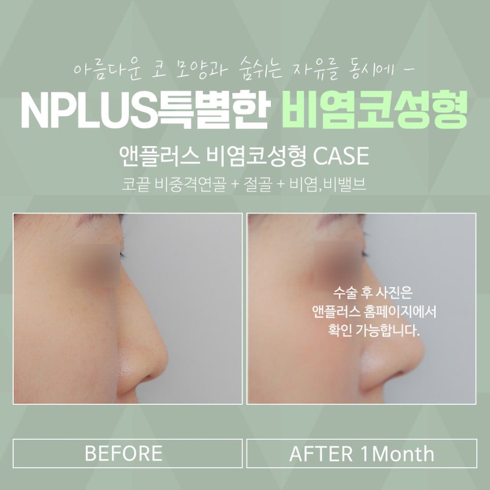 Review of Rhinitis Nose Surgery: Looking for the Differences image 14
