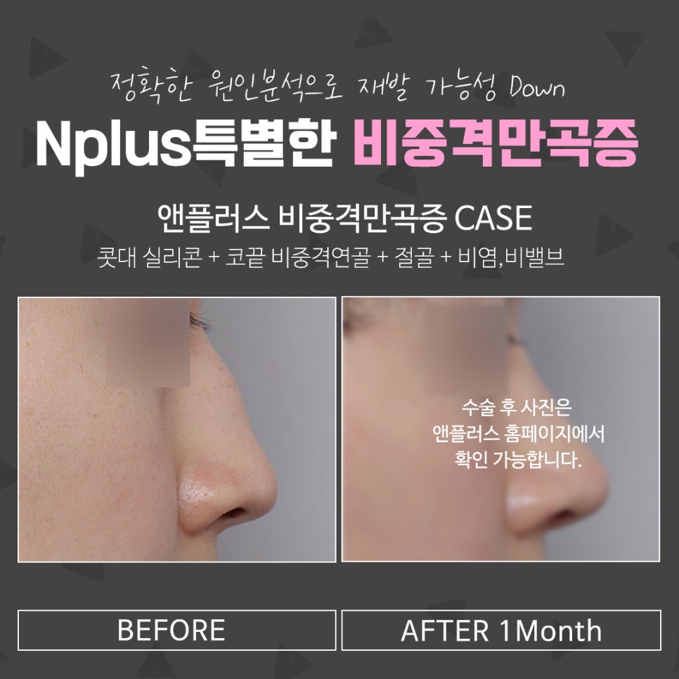 비중격만곡증수술 신중한 선택으로 관련 이미지 12