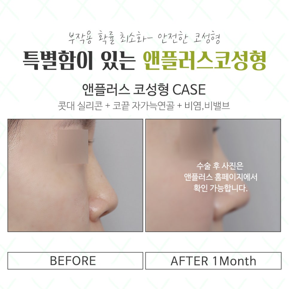 코성형전후를 찾아본다면 관련 이미지 15