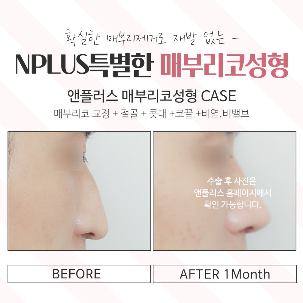 Taking a Detailed Look at Hump Nose Surgery Reviews image 16