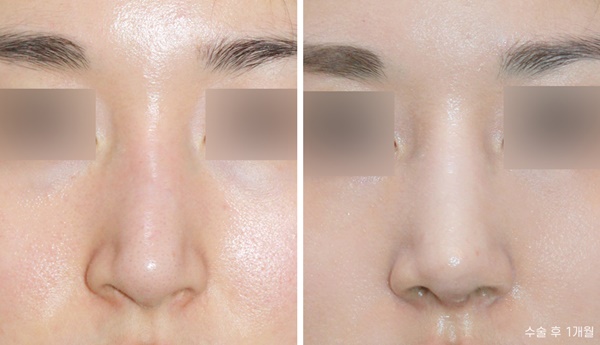 코성형 전후 사진, 앤플러스 관련 이미지 1