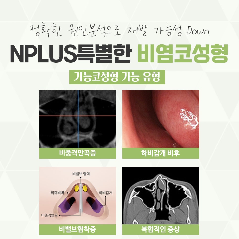비염수술코성형 다양한 요인을 확인하여 관련 이미지 5