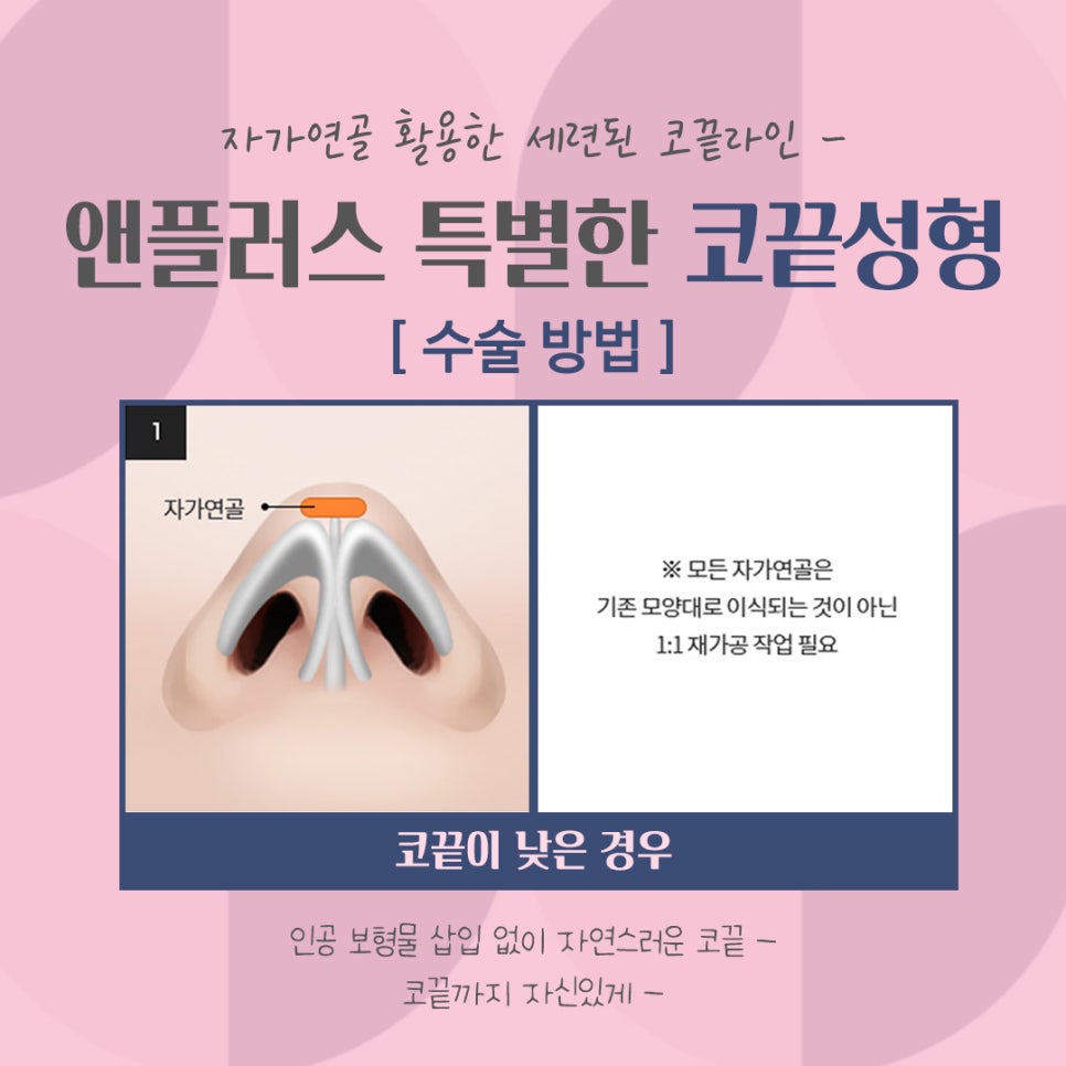 코끝처짐 개선한 코끝성형후기 관련 이미지 7