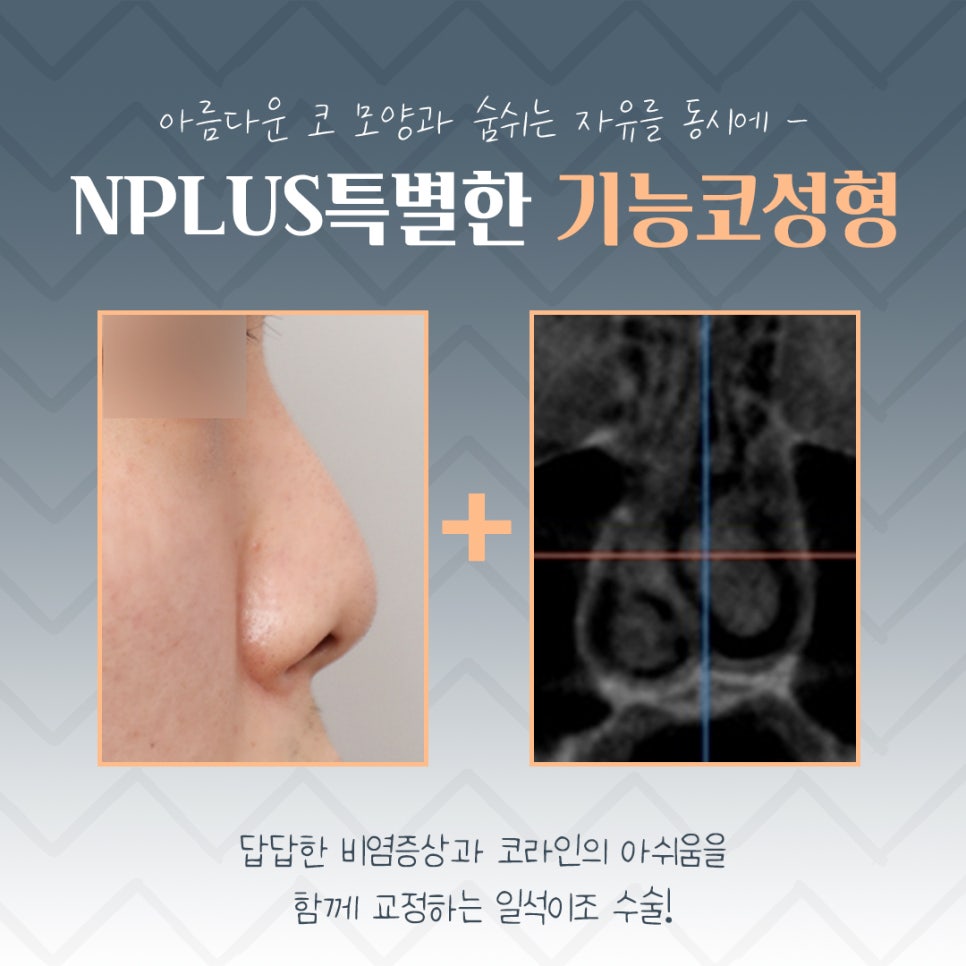If You Are Looking in Detail at Functional Nose Surgery Before and After image 3