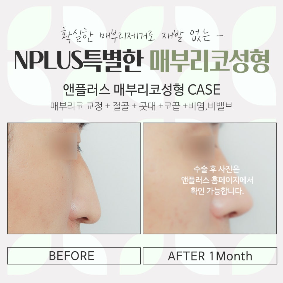 Detailed Hump Nose Surgery Review image 17