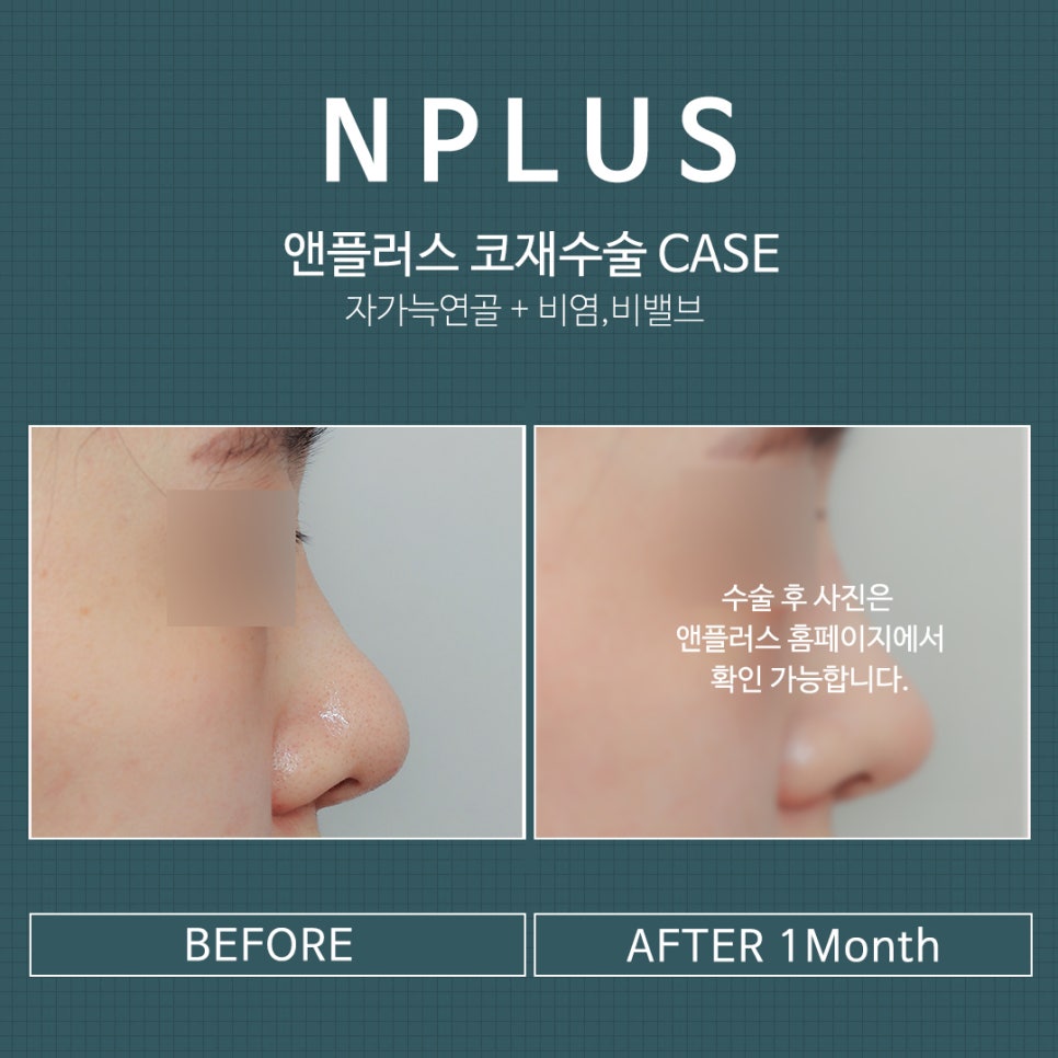 Revision Rhinoplasty Review: A Choice You Won’t Regret image 11