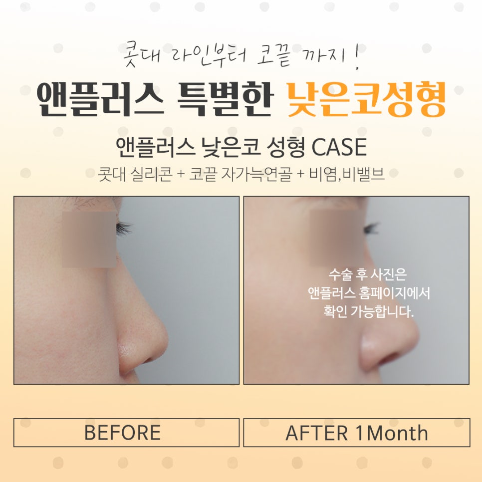 낮은코성형후기를 자세하게 찾아보고 관련 이미지 11